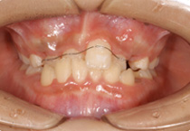 Smile Line case 1 2022.06.14