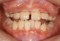 Smile Line case 1 2022.10.06