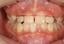 Smile Line case 1 2023.02.07