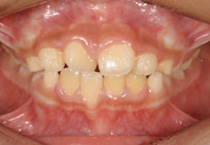 Smile Line case 2 2022.08.28