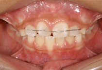 Smile Line case 2 2022.11.03