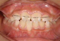 Smile Line case 2 2022.11.24