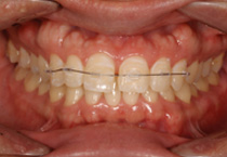 Smile Line case 3 2022.06.14