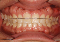 Smile Line case 3 2022.10.06