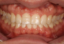 Smile Line case 3 2023.02.07