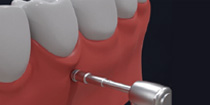 Orthodontic Mini implant