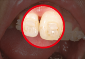 Before proceeding with the Proximal Stripper