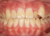 Smile Line case 1 2022.02.20