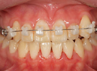 Smile Line case 1 2022.03.16