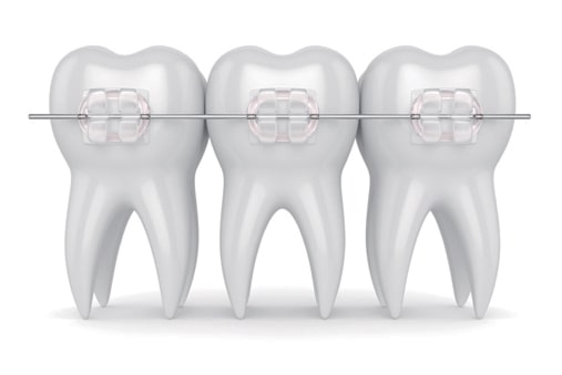 clear ceramic orthodontic brackets on teeth